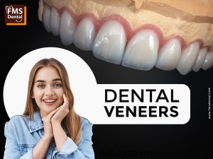 Dental Veeners in Hyderabad India