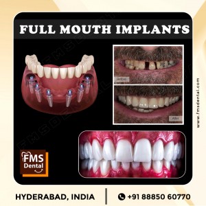 Full Mouth Dental Implants in Hyderabad India