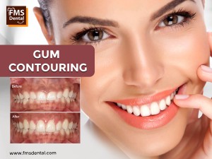 Gum Contouring Treatment in Hyderabad