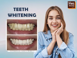 Tooth Whitening Treatment in Hyderabad