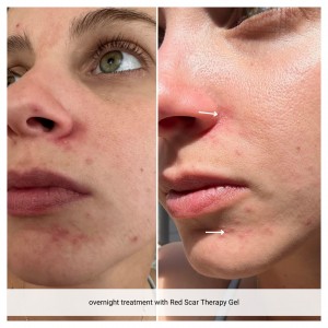 Médicii Laboratories' New Concept for Growing Hair using an ingredient for Acne