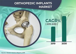Orthopedic Implant Market: Size, Share, Strategies, Product Sales, Growth Rate and Analysis by 2030