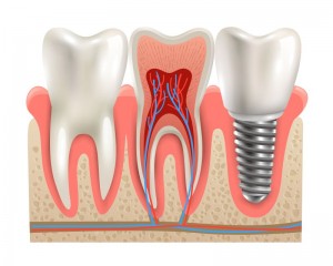 Progressive Dentistry Dental Implants