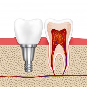 dental implants aveley