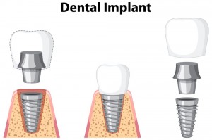 Dental Implant Services