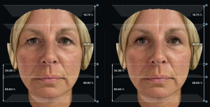 Left before and Right after upper eyelid surgery with 1/3 rule