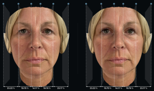 Left before and Right after upper eyelid surgery with 1/5 rule