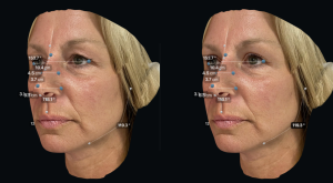 Left before and Right  after upper eyelid surgery with facial measurements 45 degree view