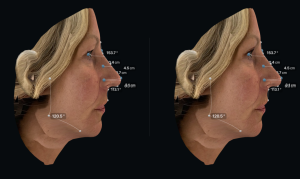 Left before and Right after upper eyelid surgery with facial measurements side profile