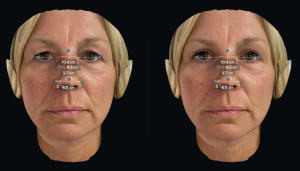 Left before and Right after upper eyelid surgery with facial measurements
