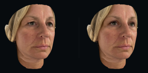 Left before and Right after upper eyelid surgery without measurements