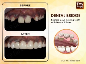 Dental Bridge