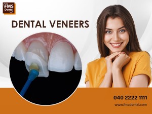 Dental Veneers in Hyderabad India
