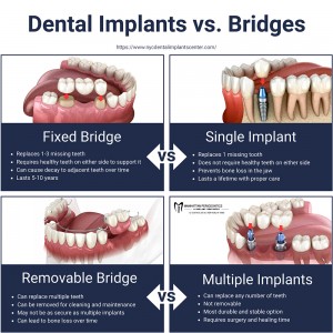 denta implants vs bridges
