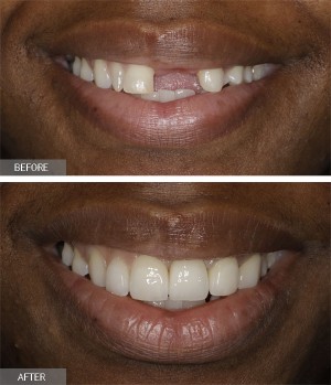 front tooth implant replacement and veneers