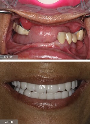 Full mouth Rehabilitation with dental implants