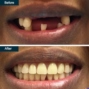 Before After Flexible Partial Dentures Dentist Yonkers NY