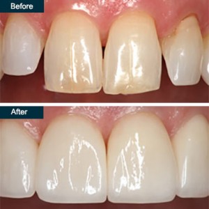 Before After Press On Dental Veneers 2 Yonkers NY