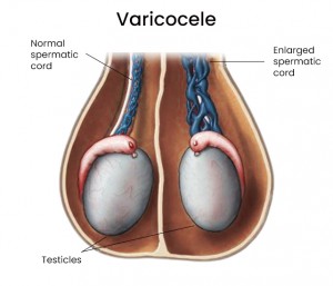 Varicoceles