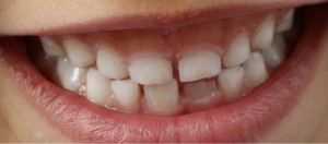 Dental Implants at Nashville Smiles - Nashville TN