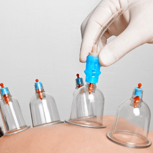 Cupping therapy