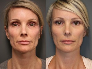 Richard Haxton’s Facial Sculpting Named Best Beauty Treatment 2024