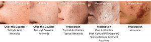 Types of Acne