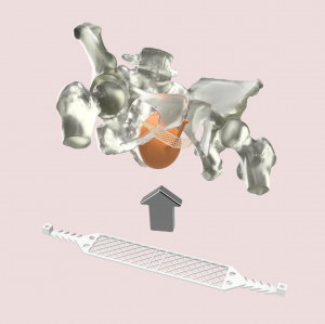 TissueDerm BIO-TOT: Supporting the Urethra