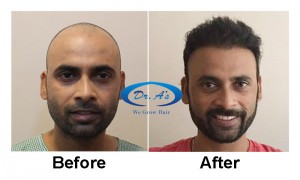 Dr. Arvind Poswal of Dr. A’s Clinic Awarded India’s No.1 Hair Transplant Surgeon.