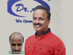 Dr. Arvind Poswal of Dr. A’s Clinic Awarded India’s No.1 Hair Transplant Surgeon.