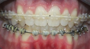 after fastbraces