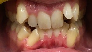 open bite and severe crowding before
