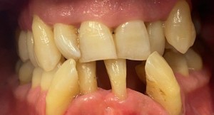very severe periodontal case before