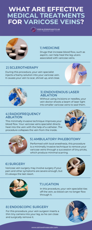 What Are Effective Medical Treatments for Varicose Veins