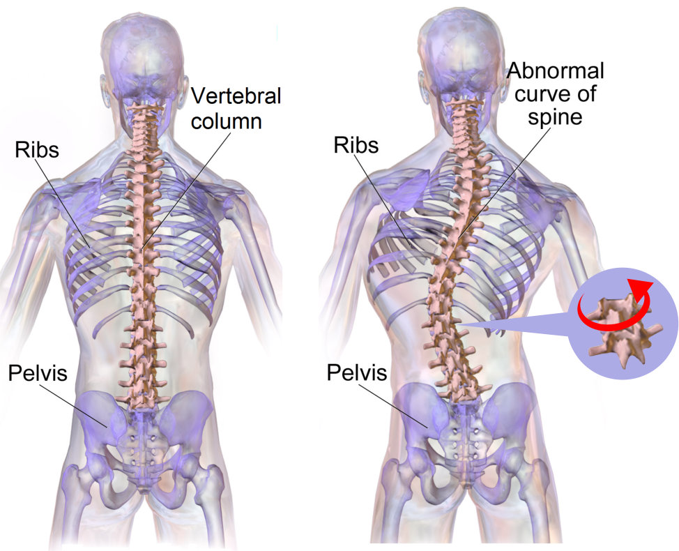 Scoliosis Management Market Scoliosis Management Market
