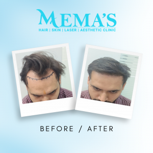best hair transplant clinic in Jaipur