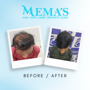best hair transplant clinic in Jaipur