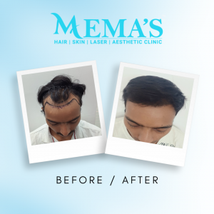 best hair transplant clinic in Jaipur