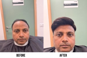 Advanced Hair Patch Solutions in Delhi & Gurugram