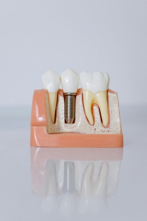 East York Clinic Dental Implant Model