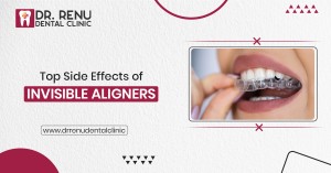 Dr Renu blog teeth white new design aligners