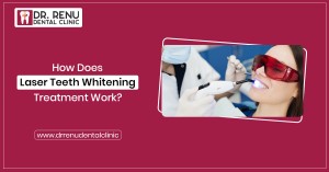 How Does Laser Teeth Whitening Treatment Work