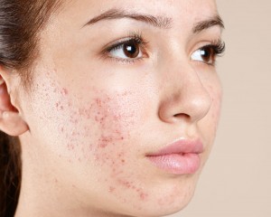 Laser Acne Treatment in Delhi