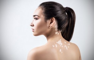 vitiligo treatment in delhi