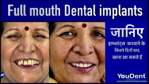 Full Mouth Dental Implant Before - After