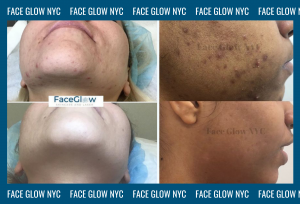 Custom Facials NYC Clear Acne Pigmentation Clogged Pores and More