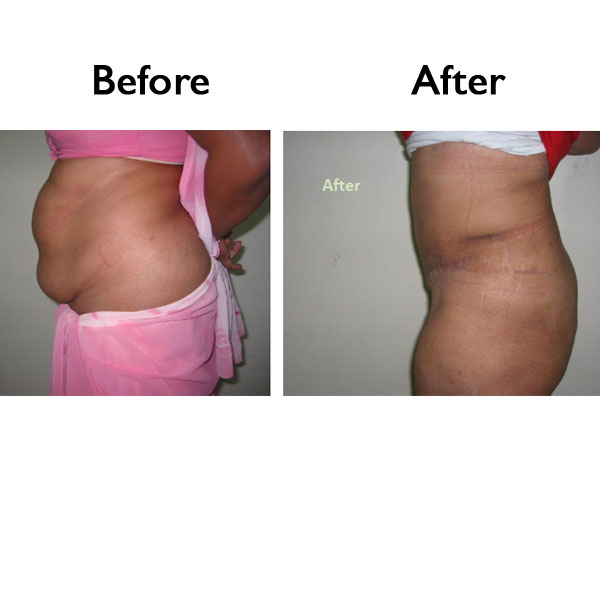 liposuction Before and After liposuction Before and After