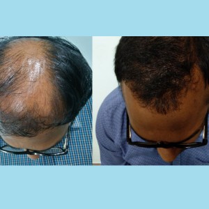 Hair Transplantation Before and After