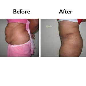 liposuction Before and After