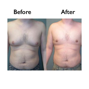 Male breast reduction Before and After